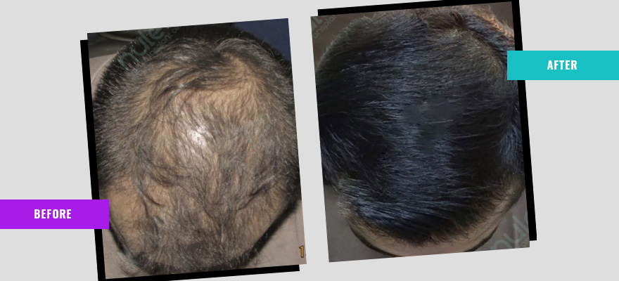 How can PRP hair treatment in Delhi help with your hair loss?